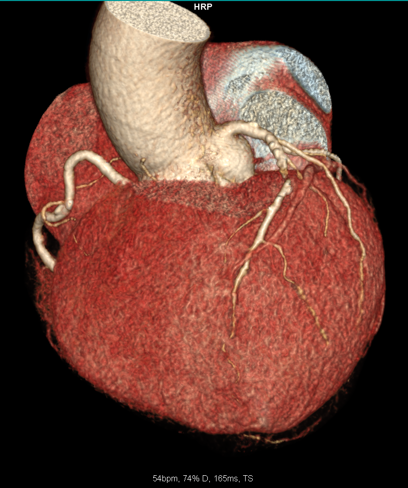 冠動脈CT　3D表示